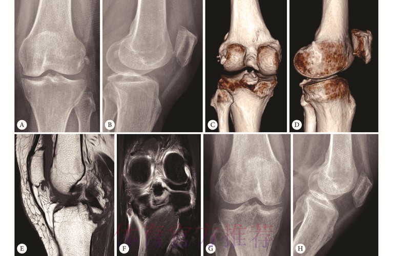 皇马官方：巴斯克斯左膝后交叉韧带扭伤